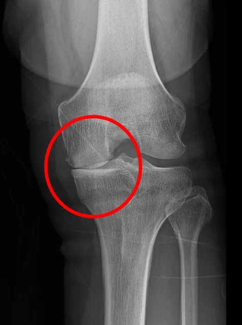 큰힘병원 무릎·인공관절 수술 전 X-ray