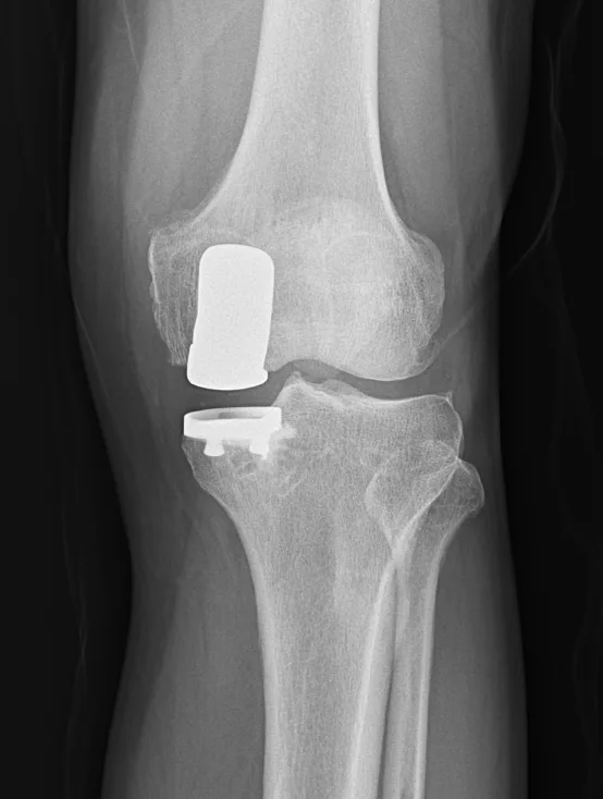 큰힘병원 무릎·인공관절 수술 후 X-ray (2)