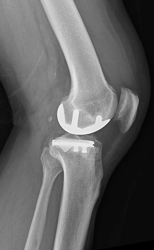 큰힘병원 무릎·인공관절 수술 후 X-ray