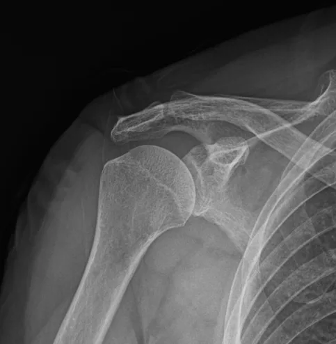 큰힘병원 어깨·팔꿈치 수술 전 X-ray