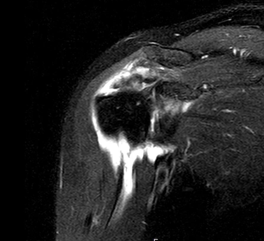 큰힘병원 어깨·팔꿈치 수술 전 MRI (3)