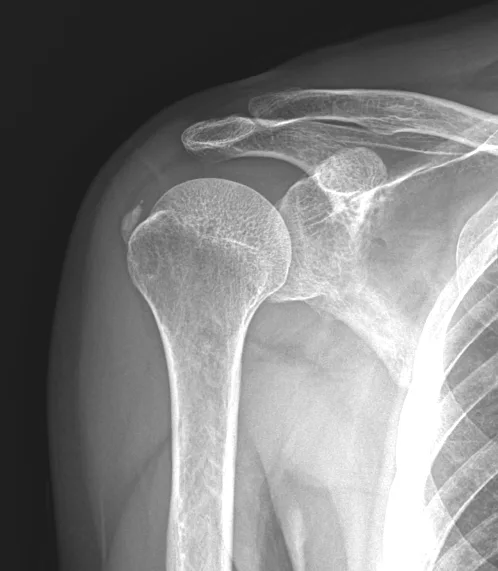 큰힘병원 어깨·팔꿈치 수술 전 X-ray