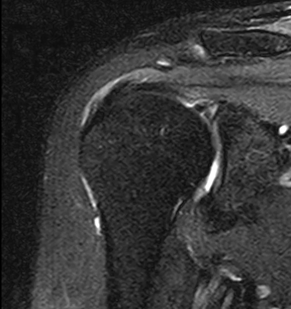 큰힘병원 어깨·팔꿈치 수술 전 MRI (2)