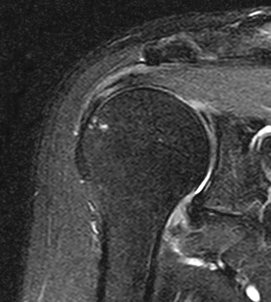 큰힘병원 어깨·팔꿈치 수술 전 MRI