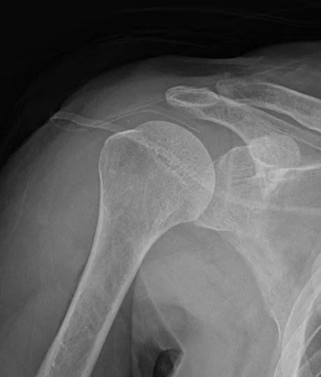 큰힘병원 어깨·팔꿈치 수술 후 X-ray