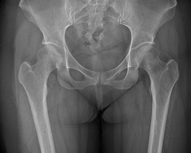 큰힘병원 고관절 수술 전 X-ray