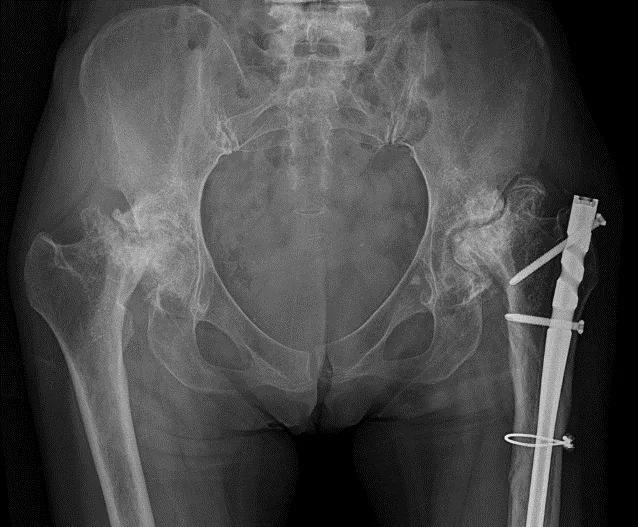 큰힘병원 고관절 수술 전 X-ray · 정상적인 고관절 사진 환자의 변형된 고관절 사진