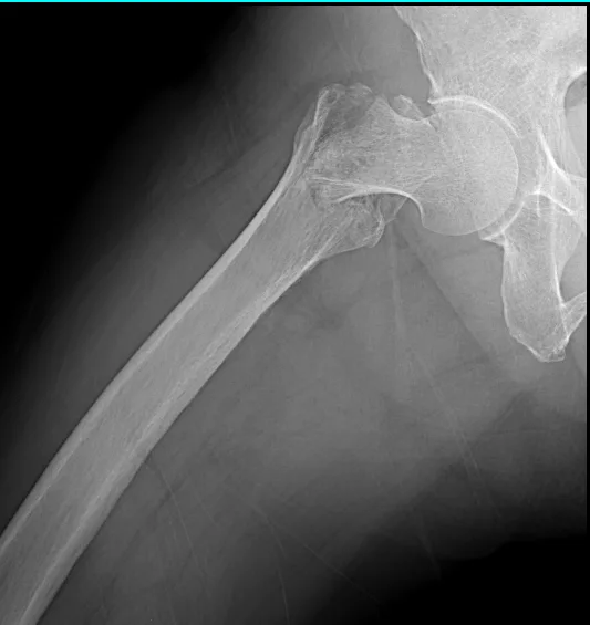 큰힘병원 고관절 수술 전 X-ray