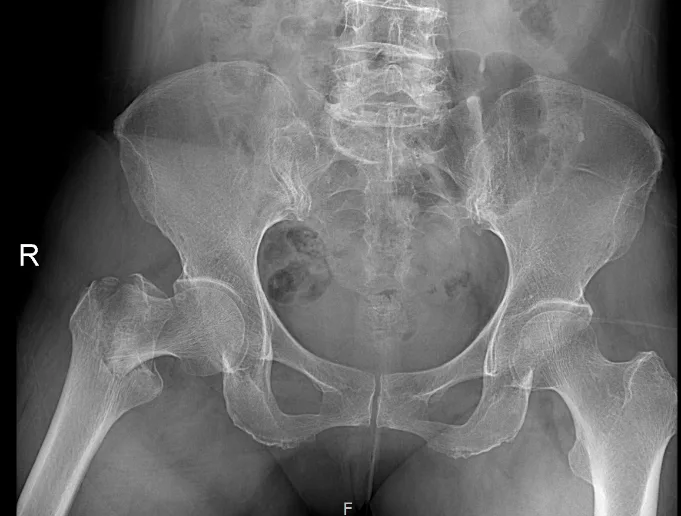큰힘병원 고관절 수술 전 X-ray (2)
