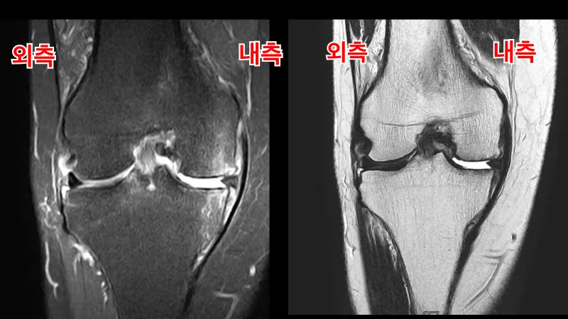 큰힘병원 무릎·인공관절 수술 전 X-ray