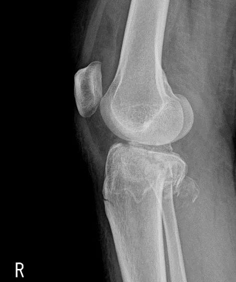 큰힘병원 무릎·인공관절 수술 전 X-ray